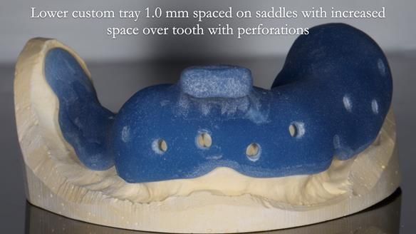 Finlay's Newsletter 61 provision of a lower unilateral free end saddle metal based partial denture for Joyce