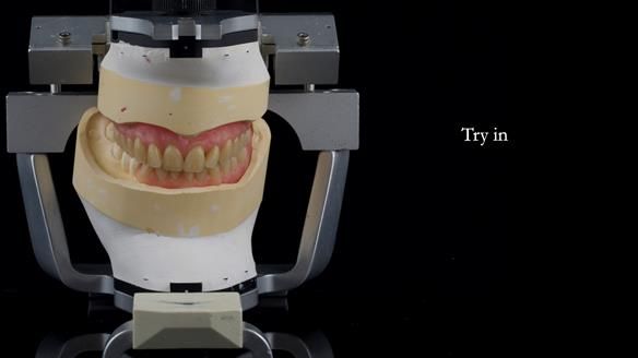 Newsletter 82 Mary - A complete upper and a one-tooth gasket denture