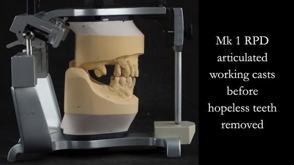 Finlay's Case Study Newsletter 40 - Immediate Mk 1 RPD to Definitive Mk 2 RPD - full protocol