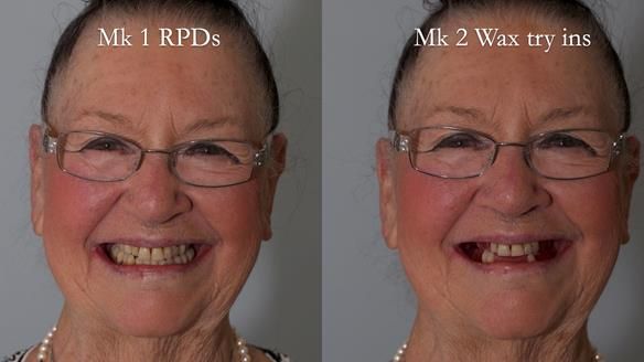 Finlay's Case Study Newsletter 40 - Immediate Mk 1 RPD to Definitive Mk 2 RPD - full protocol