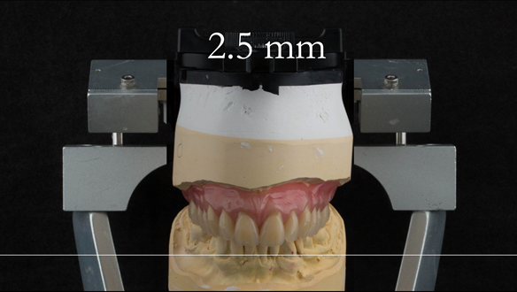 Figure 29 Mk 1 immediate denture - incisal plane lifted by 2.5 mm
