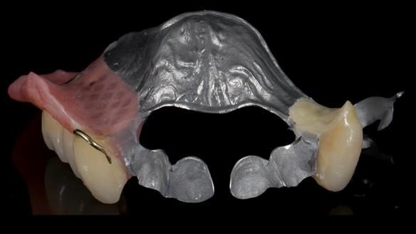 Newsletter 86 Peter the Architect — precision removable partial dentures case study