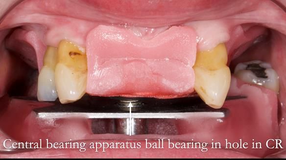 Finlay's Newsletter 59 Ultra hard partial dentures made for Gill