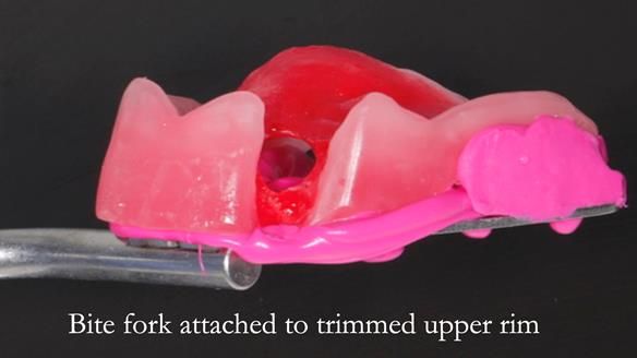 Finlay's Newsletter 59 Ultra hard partial dentures made for Gill