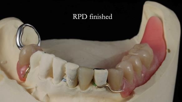 Newsletter 55 Provision of metal based partial dentures for Zephyrine with a repaired cleft lip and palate