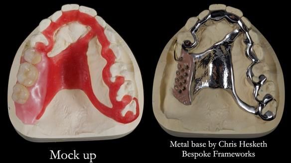 Finlay's Newsletter 64 case study - provision of a Kennedy class 2 metal based Scandinavian RPD for Ian