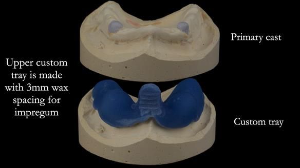 Newsletter 57 showcases the making and fitting process of implant-supported complete dentures for Alisdair