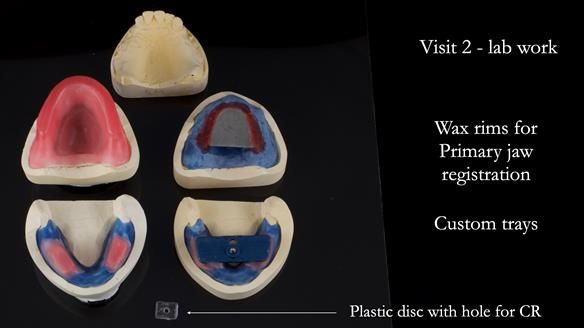 Finlay's Newsletter 62 provision of extractions and metal based complete dentures for Rafique
