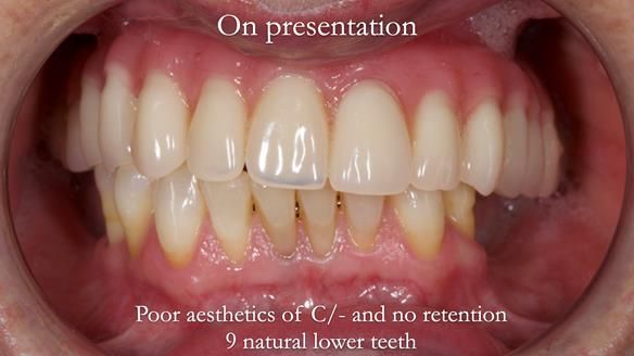 Solving Linda’s Failed “All on 4” implant bridges - full protocol Newsletter 42