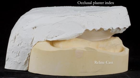 Newsletter 54 case presentation upper complete denture and lower Scandinavian designed hygienic partial denture for David