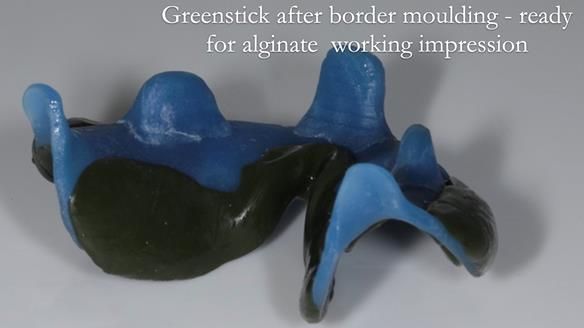 Newsletter 53 showing the making and fitting of ultra life-like dentures for Valena