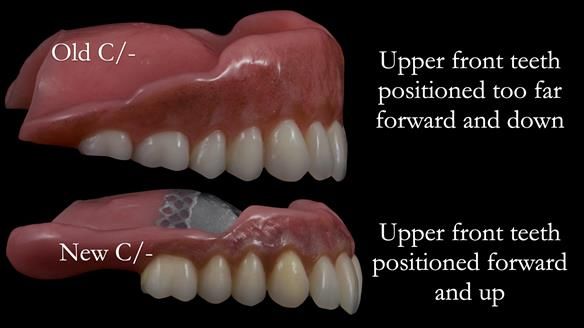 Newsletter 53 showing the making and fitting of ultra life-like dentures for Valena