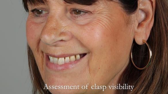 Newsletter 56 showing the making and fitting of a bilateral free end saddle upper removable partial denture (RPD) for patient with pemphigus