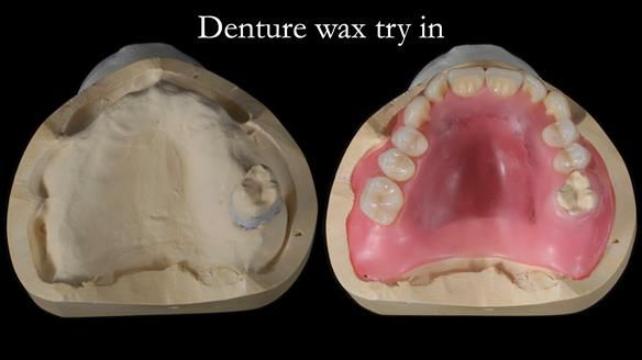 Finlay's Newsletter 58 Gasket upper partial denture for Zoe