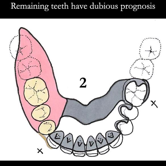 Universal Scandinavian partial denture designs