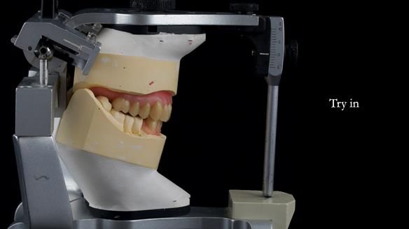 Newsletter 82 Mary - A complete upper and a one-tooth gasket denture