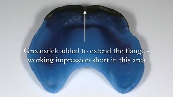 Newsletter 53 showing the making and fitting of ultra life-like dentures for Valena