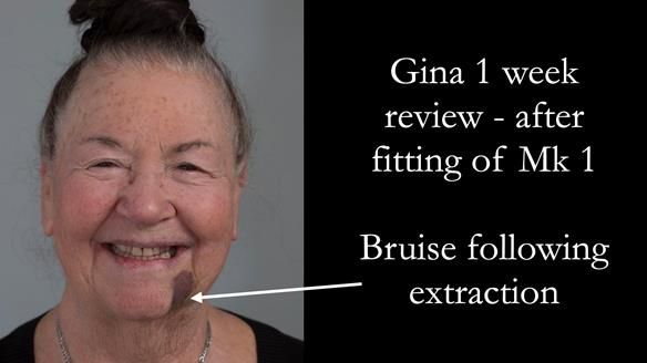 Finlay's Case Study Newsletter 40 - Immediate Mk 1 RPD to Definitive Mk 2 RPD - full protocol