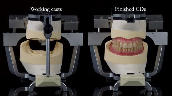 Newsletter 83: Sheila’s Complete Denture Success