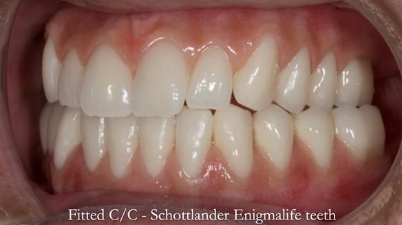 Managing poor implant positioning with complete dentures and Locator attachments - full protocol Newsletter 41
