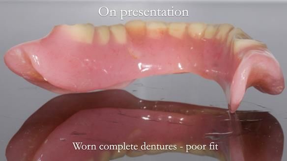 Newsletter 57 showcases the making and fitting process of implant-supported complete dentures for Alisdair