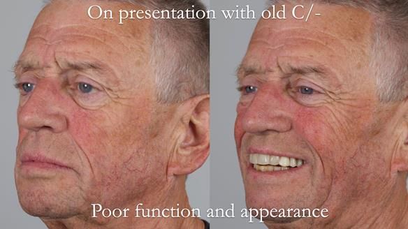 Newsletter 54 case presentation upper complete denture and lower Scandinavian designed hygienic partial denture for David