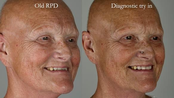 Newsletter 81 - Pam’s Story — how a partial denture changed her life (+ live walkthrough this Thursday)