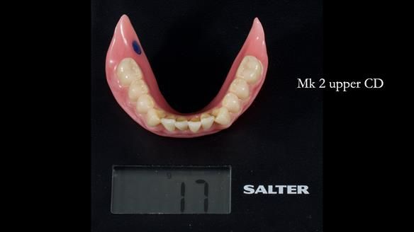 Newsletter 83: Sheila’s Complete Denture Success