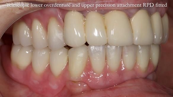 Newsletter 76: Jackie’s case – Telescopic overdenture & precision RPD (the tricky truth!)