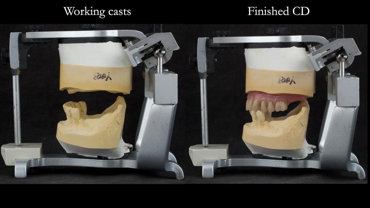 Newsletter 87 – Father Peter: A Partial Denture that needed Minor Miracle