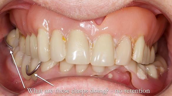 Newsletter 82 Mary - A complete upper and a one-tooth gasket denture