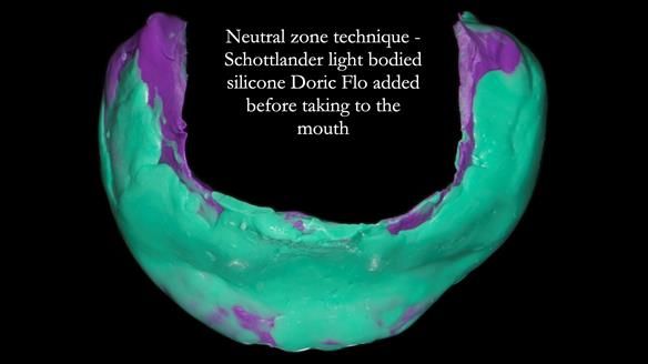 Newsletter 83: Sheila’s Complete Denture Success