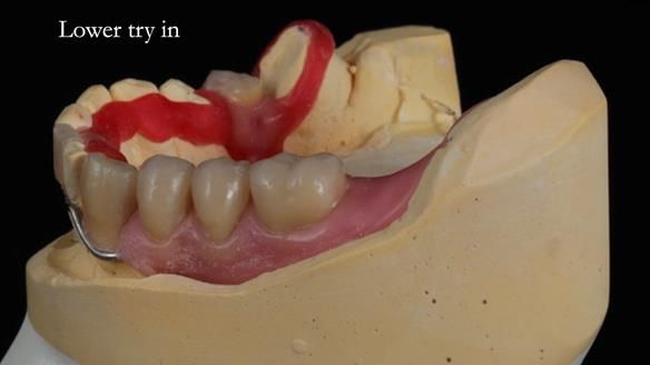 Newsletter 55 Provision of metal based partial dentures for Zephyrine with a repaired cleft lip and palate