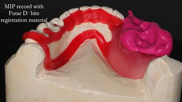 Finlay's Newsletter 61 provision of a lower unilateral free end saddle metal based partial denture for Joyce