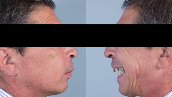 Figure 3 Pre-treatment with generalised periodontitis; stage IV grade C, unstable, risk factors: recent smoker. Prior to phase one treatment of immediate complete upper denture and immediate mandibular acrylic based partial denture.