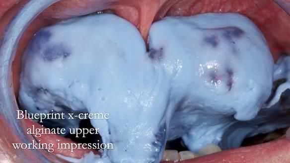 Newsletter 77: Jeremy’s case – immediate complete upper denture