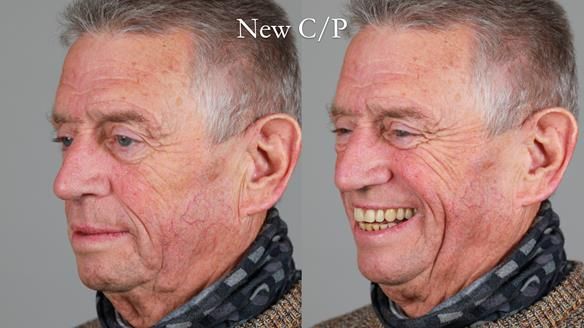 Newsletter 54 case presentation upper complete denture and lower Scandinavian designed hygienic partial denture for David