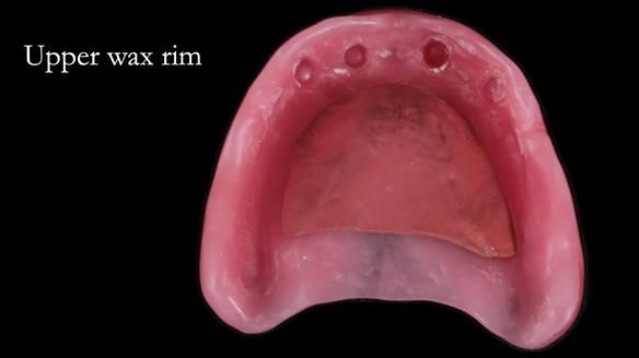 Newsletter 65 Marisa Provision of Complete Dentures on badly placed implants