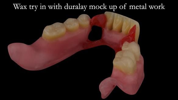 Finlay's Case Study Newsletter 40 - Immediate Mk 1 RPD to Definitive Mk 2 RPD - full protocol