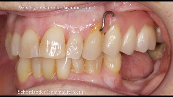 Finlay's Newsletter 60 Sylvia's upper Kennedy Class 2 Mod 1 metal based upper RPD