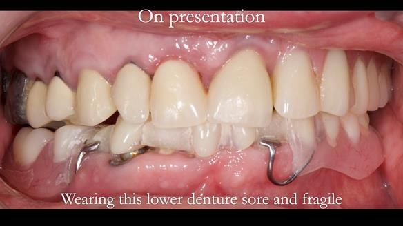 Newsletter 44 - extreme removable prosthodontics – engineering a super-strong and ultra-thin over denture