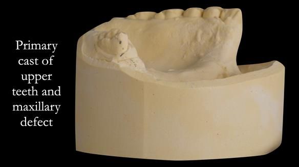 Upper metal base partial denture/occlusal stabilisation splint/obturator - full protocol