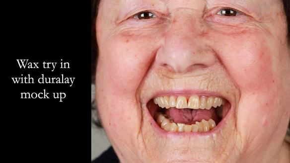 Finlay's Newsletter 60 Sylvia's upper Kennedy Class 2 Mod 1 metal based upper RPD