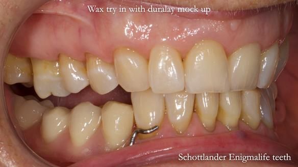 Finlay's Newsletter 61 provision of a lower unilateral free end saddle metal based partial denture for Joyce