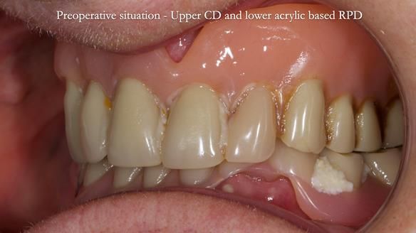 Newsletter 82 Mary - A complete upper and a one-tooth gasket denture