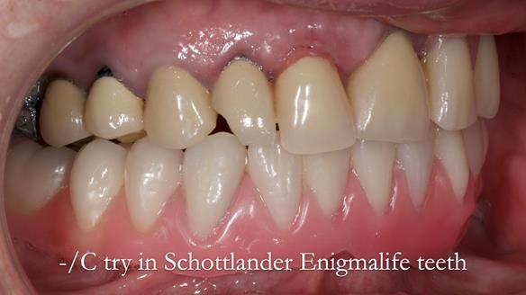 Newsletter 44 - extreme removable prosthodontics – engineering a super-strong and ultra-thin over denture