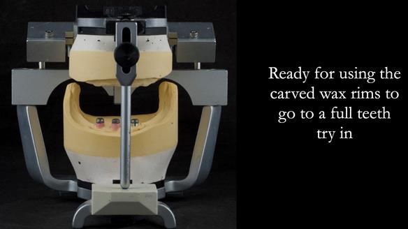 Rowan then uses the carved wax rims to set up the teeth.