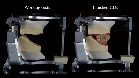 Newsletter 83: Sheila’s Complete Denture Success