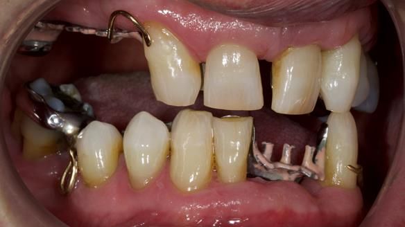 Newsletter 86 Peter the Architect — precision removable partial dentures case study