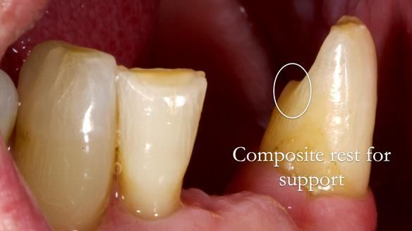 Newsletter 86 Peter the Architect — precision removable partial dentures case study